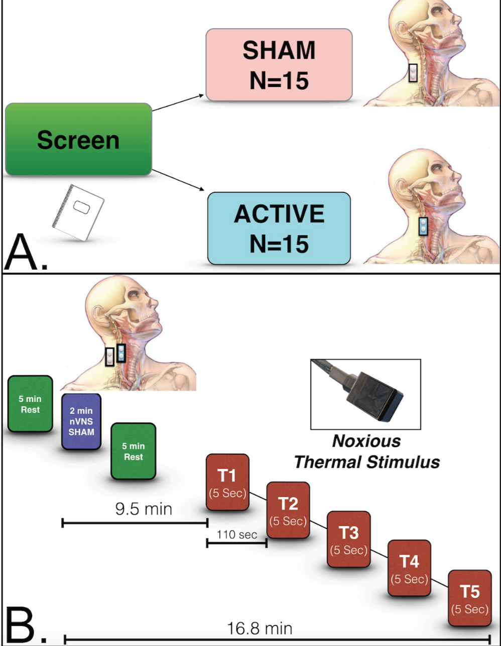 New Chronic Pain and PTSD Treatment: Noninvasive Vagus Nerve ...